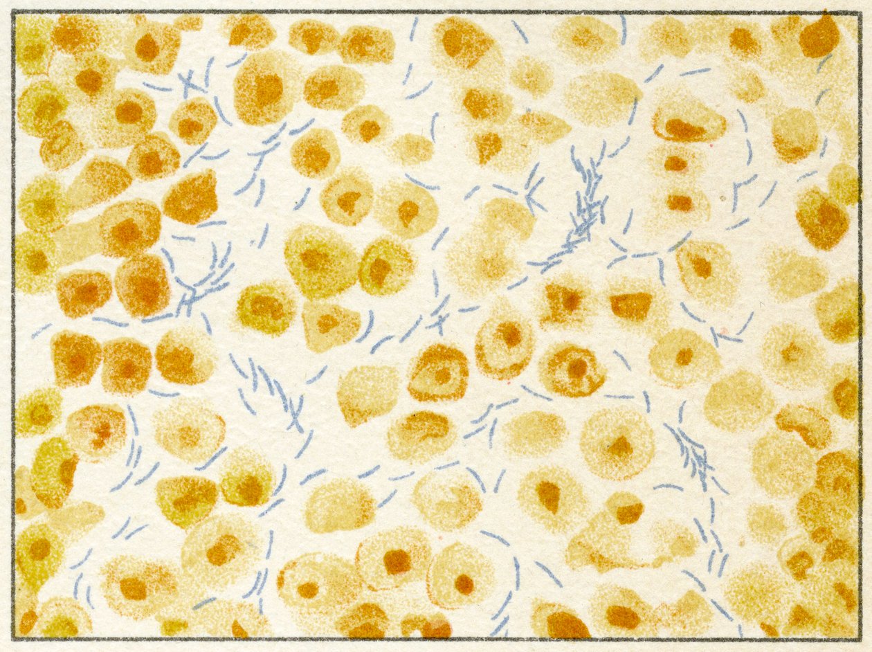 Bactéries de la tuberculose dans les crachats - German School