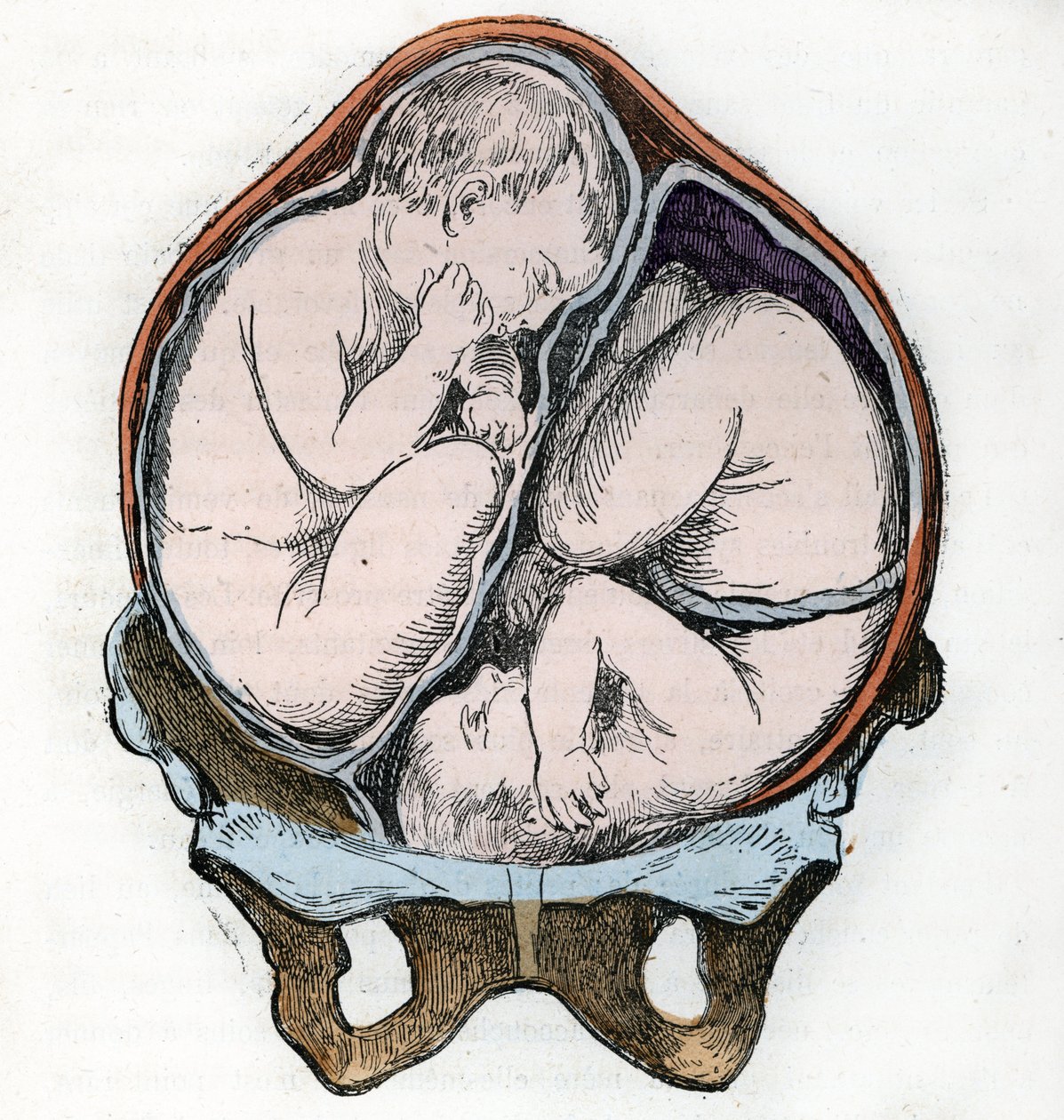 Représentation de la bonne position de deux fœtus pendant une grossesse gémellaire Gravure tirée de 