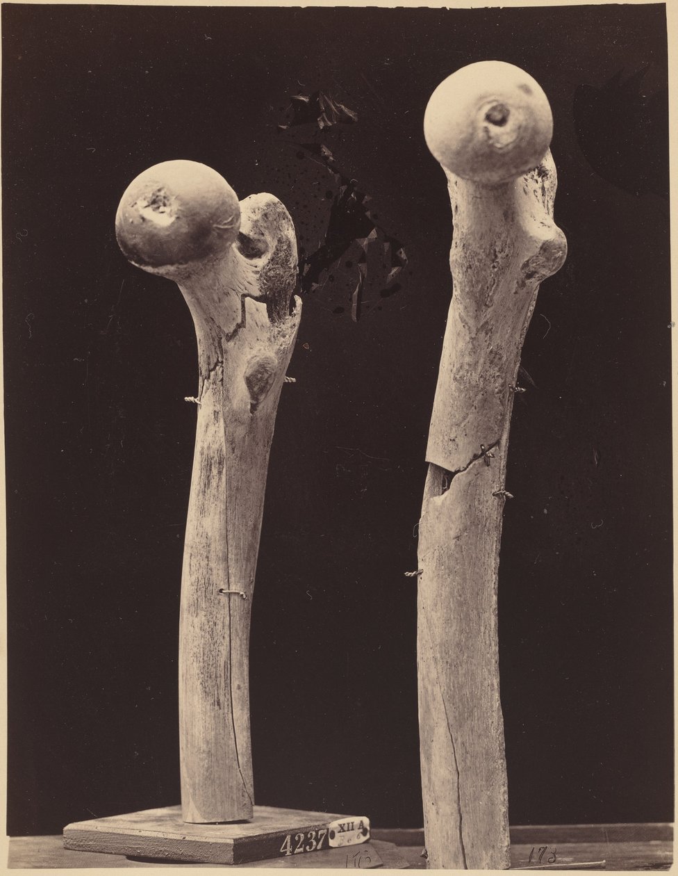 Spécimens de fractures du fémur par balle, c. 1867 (photo) - American Photographer