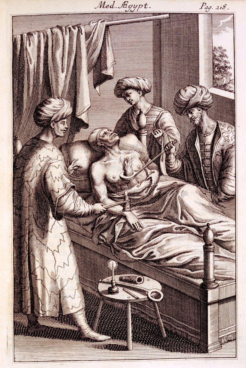 Illustration de la moxibustion de Medicina Aegyptorum par Prospero Alpinus, 1745 - American School