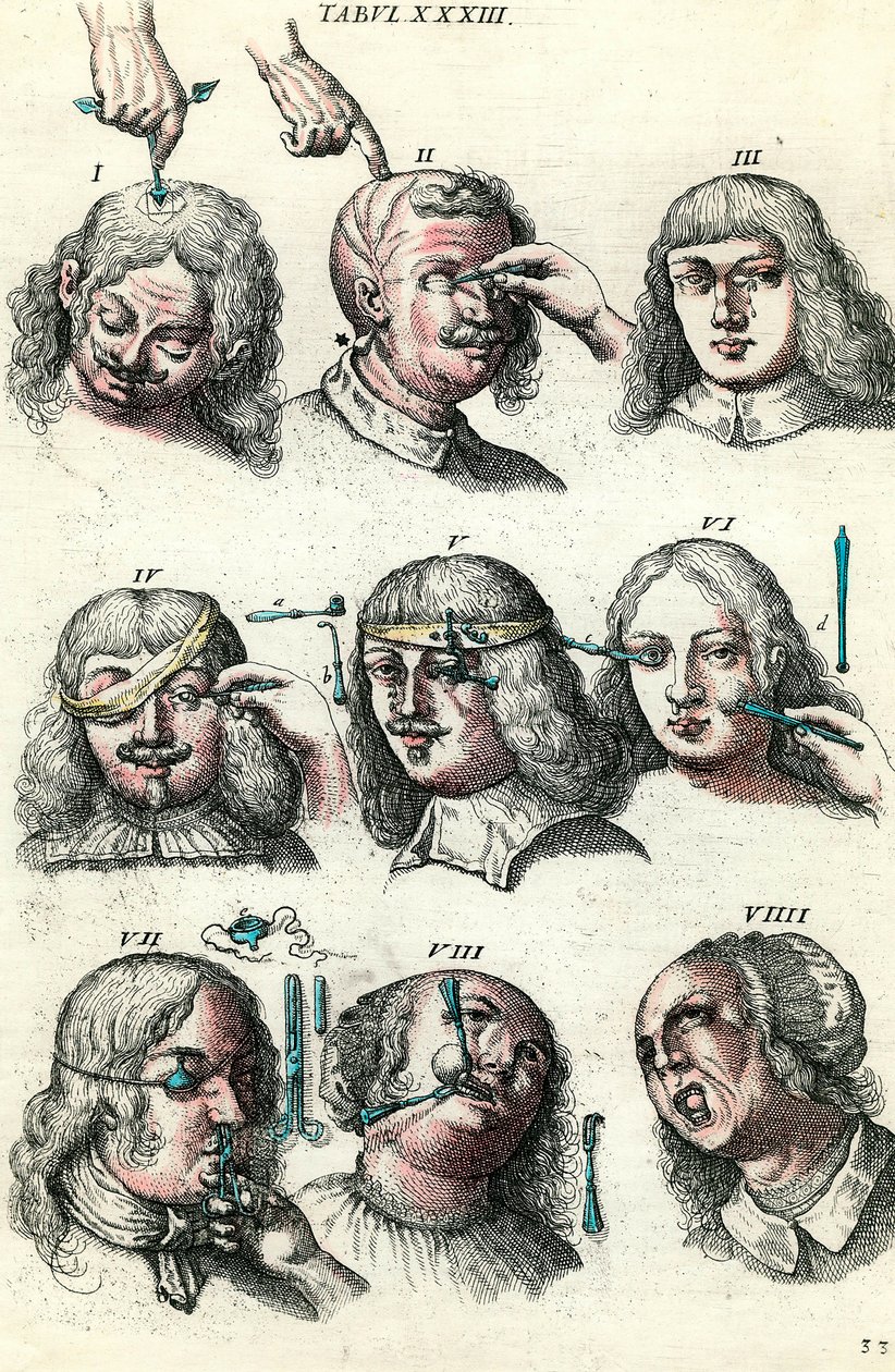 Chirurgie au XVIIIe siècle : trépanation et opération de l