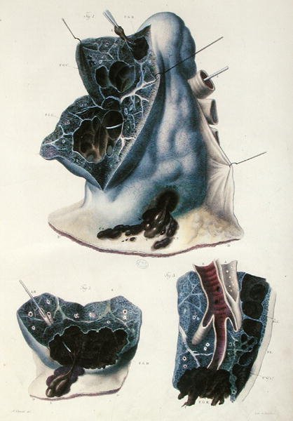 Maladies des poumons, de 
