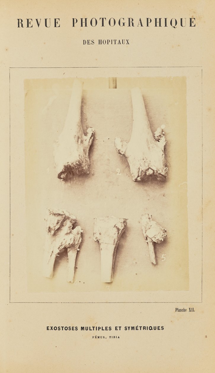 Exostoses multiples et symétriques, fémur, tibia - Arthur de Montmeja