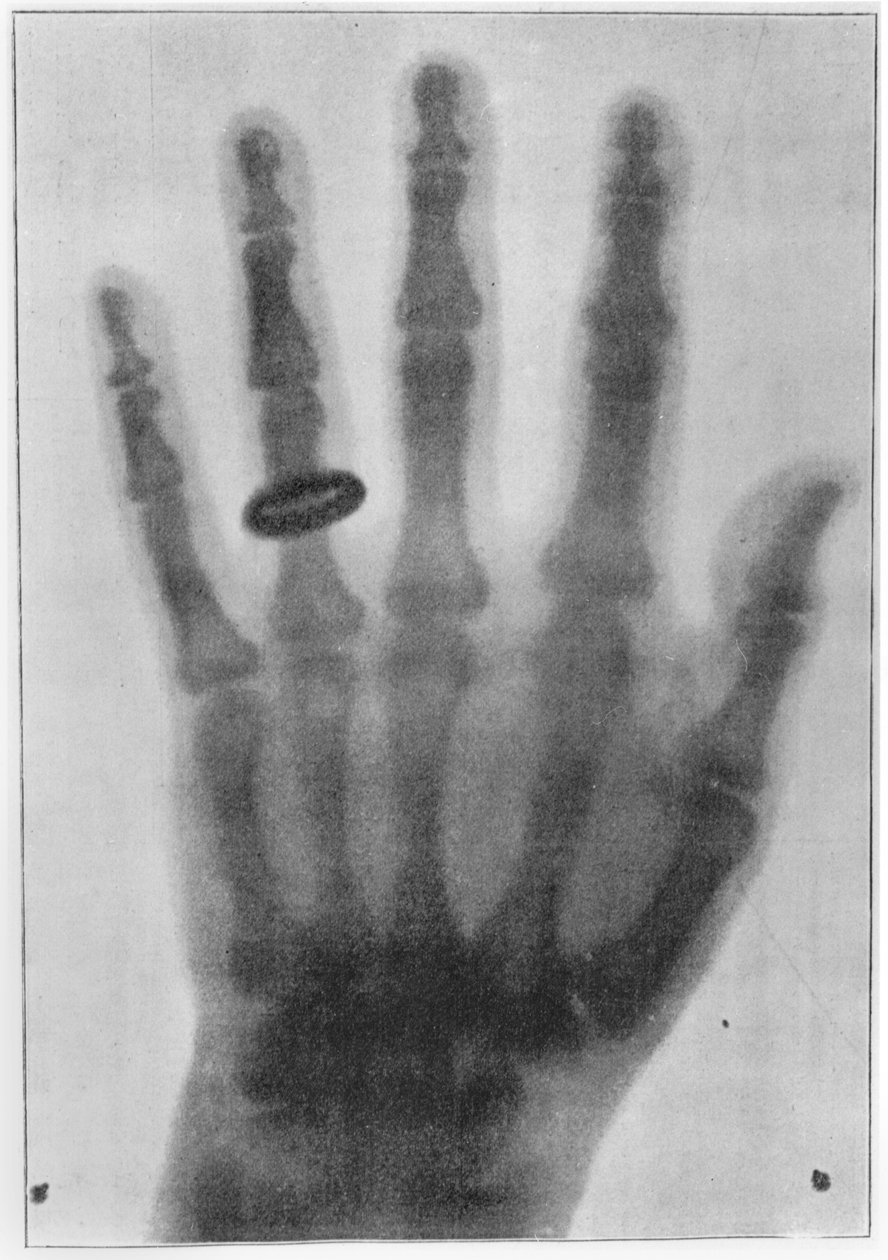 Radiographie de la main gauche d