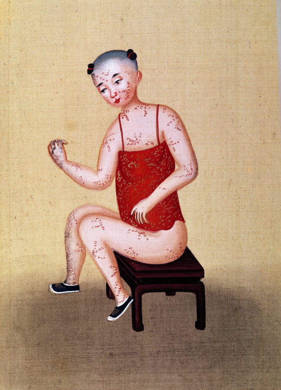 Enfant avec la variole - Chinese School