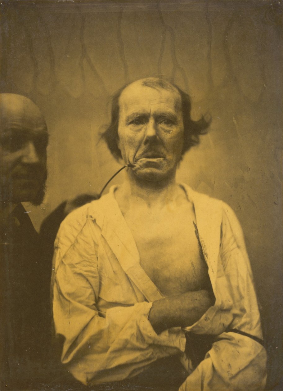 Expression détendue à gauche, dégoût à droite, 1854-1856, imprimé en 1862 - Duchenne de Boulogne