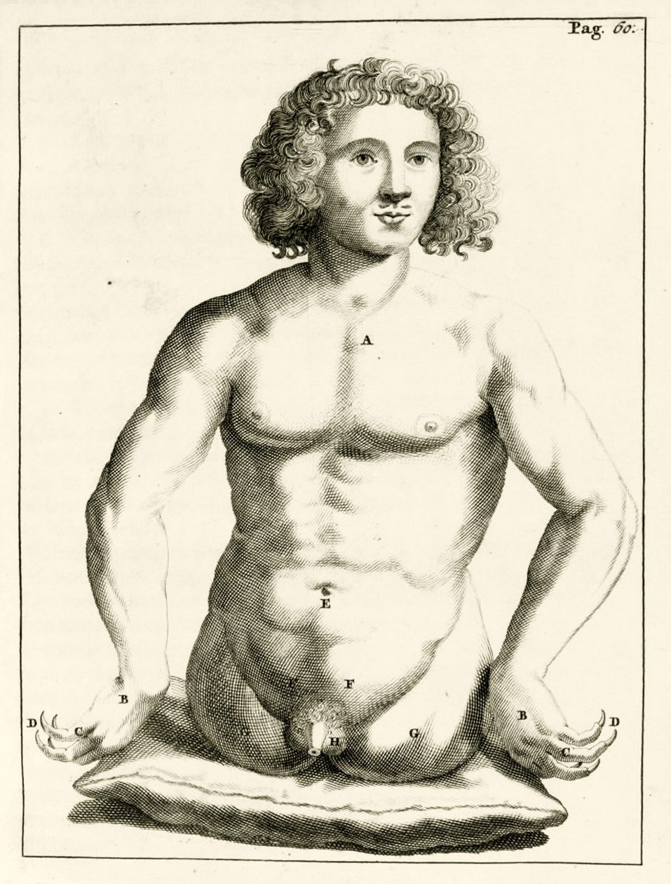 Exemple de malformations congénitales, de Exercitationes Practicae circa Medendi Methodum par Frederik Dekkers, 1694 - Dutch School