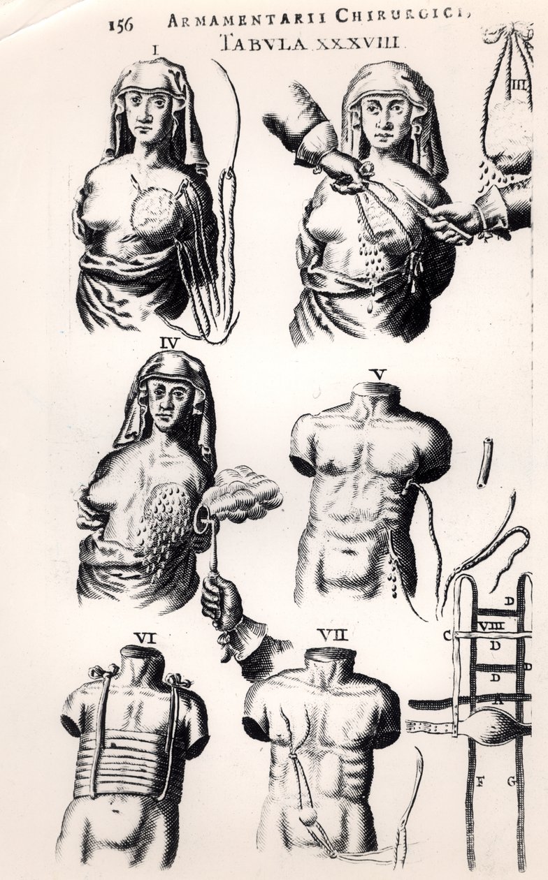 Opération sur un cancer du sein, de Armamentarii Chirurgici par Johannes Schultes (1595-1645) publié à Amsterdam, 1672 - Dutch School