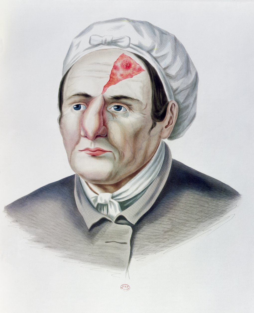 Après une opération de greffe de peau, de la Selecta Praxis Medico-Chirurgica par Alexander Auvert, Paris, 1856 - French School