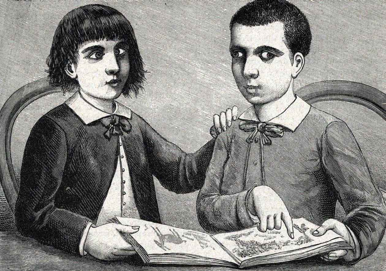 Enfants avec strabisme convergent et divergent ou yeux croisés (gravure) 1888 - French School