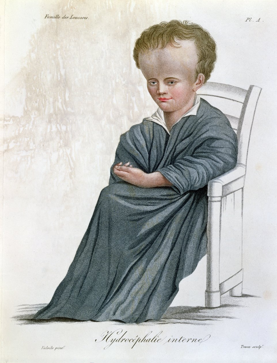 Hydrocéphalie interne, de Nosologie Naturelle par Baron Jean Louis Alibert (gravé par Tresca, 1817) - French School