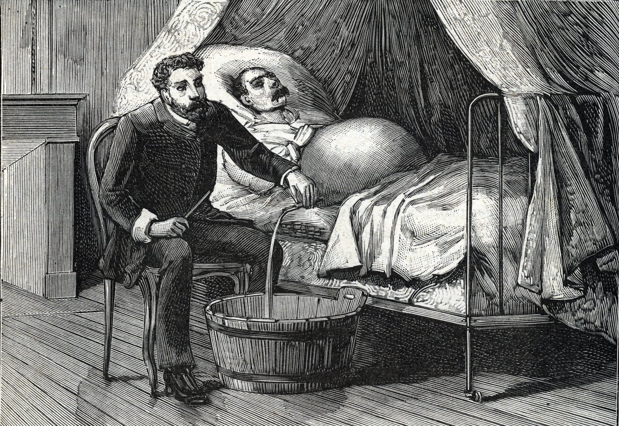 Patient avec cirrhose hépatique avancée, docteur effectuant une ponction (gravure) 1888 - French School
