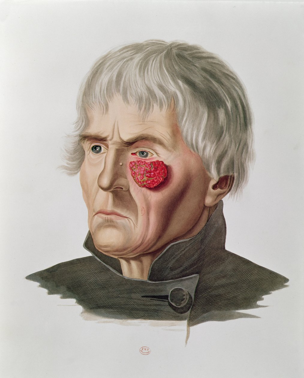 Maladie de la peau avant une opération, tiré de Selecta Praxis Medico-Chirurgica par Alexander Auvert, Paris, 1856 - French School