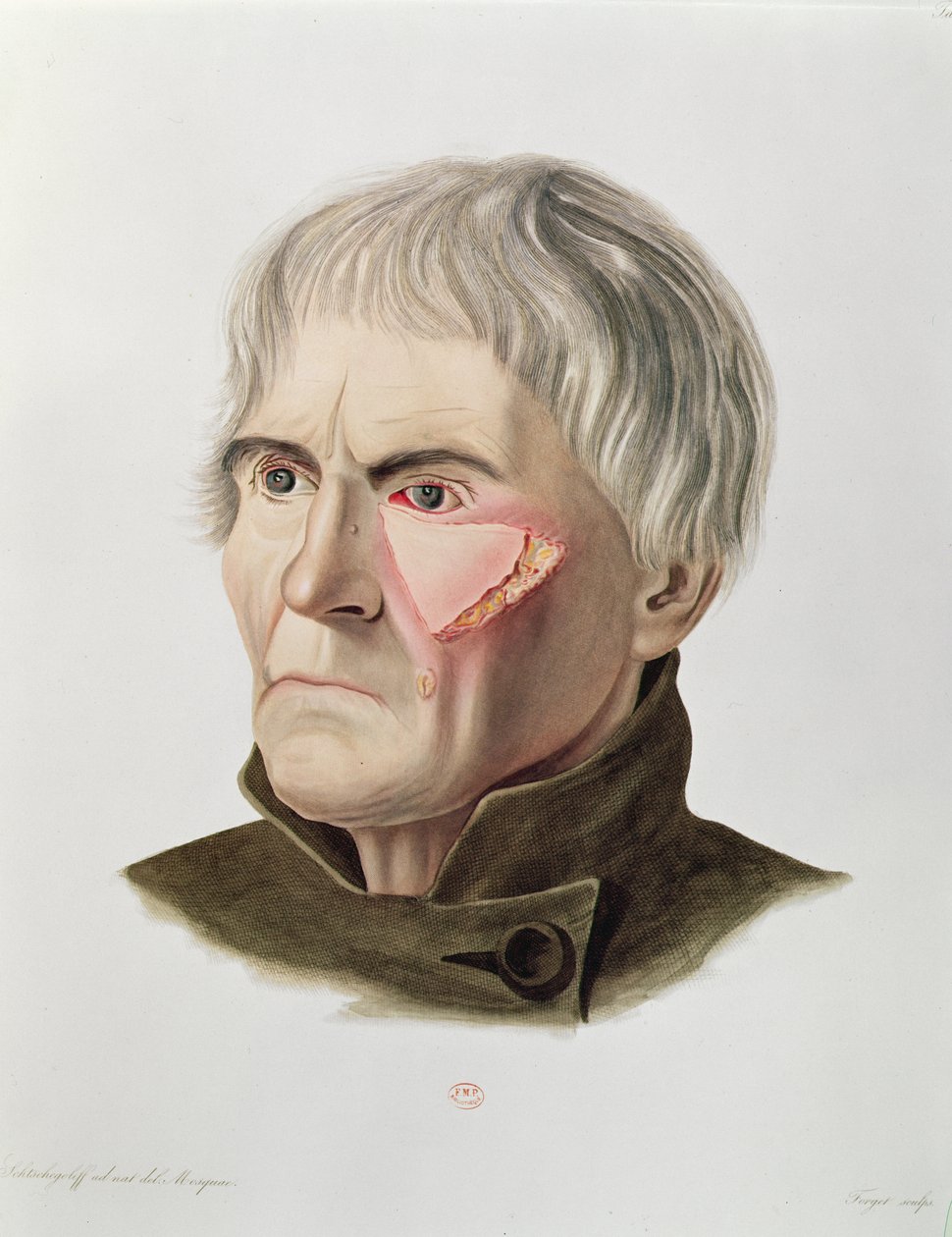 Opération de greffe de peau, tiré de Selecta Praxis Medico-Chirurgica par Alexander Auvert, Paris, 1856 - French School