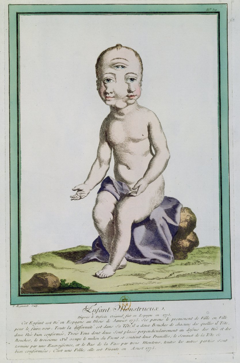 Enfant avec une tête déformée, de 