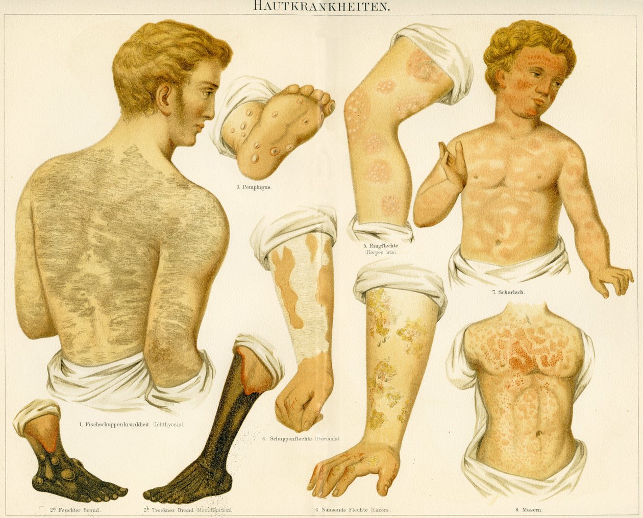 Troubles cutanés, c.1890 - German School
