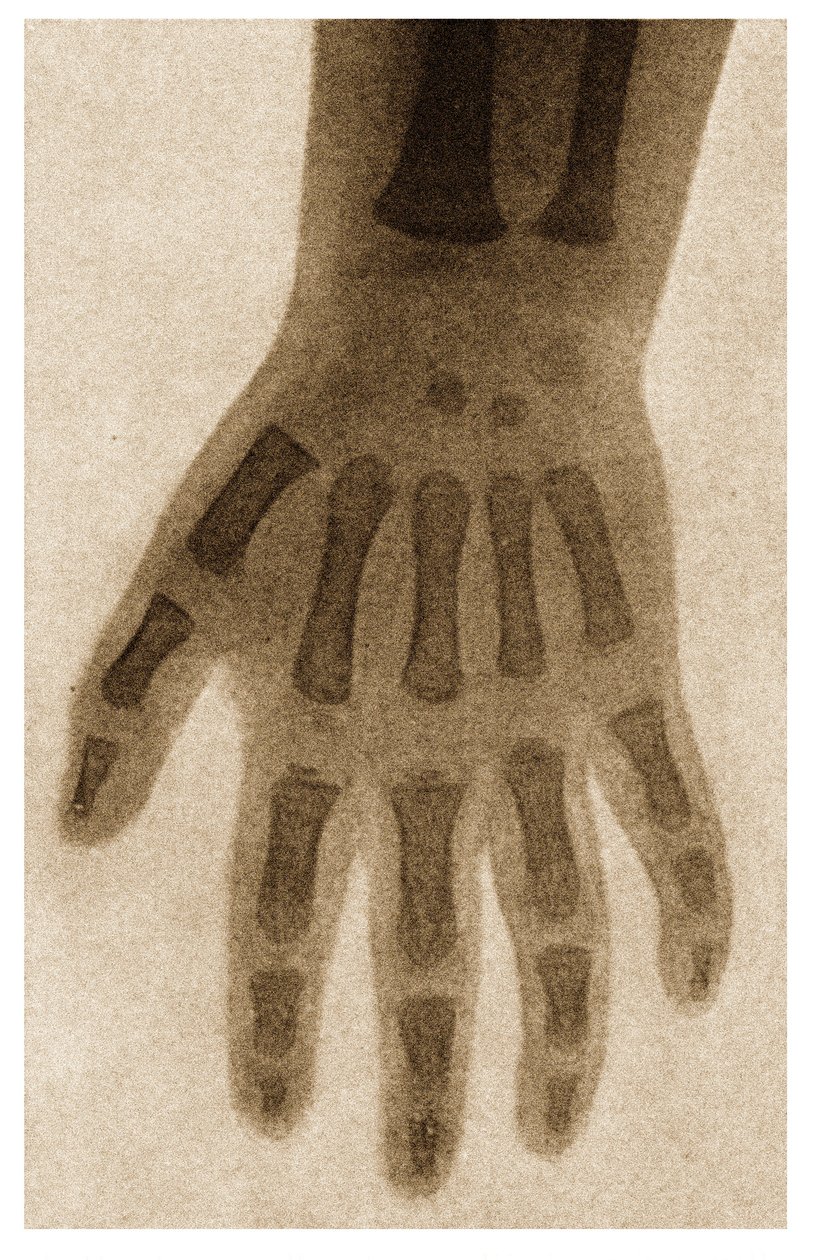 Radiographie de la main d