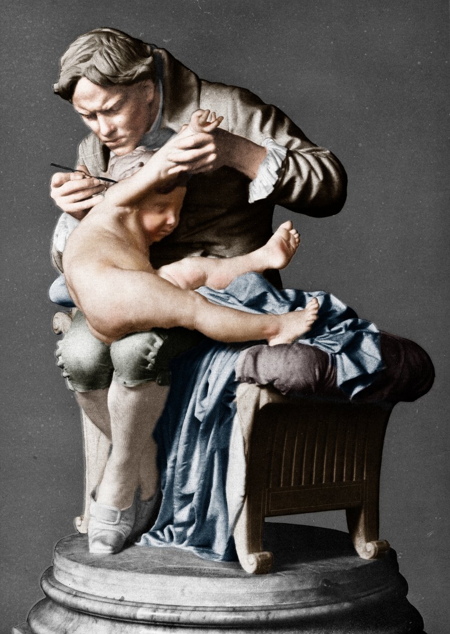 Edward Jenner, médecin anglais, vaccinant son fils - Giulio Monteverde
