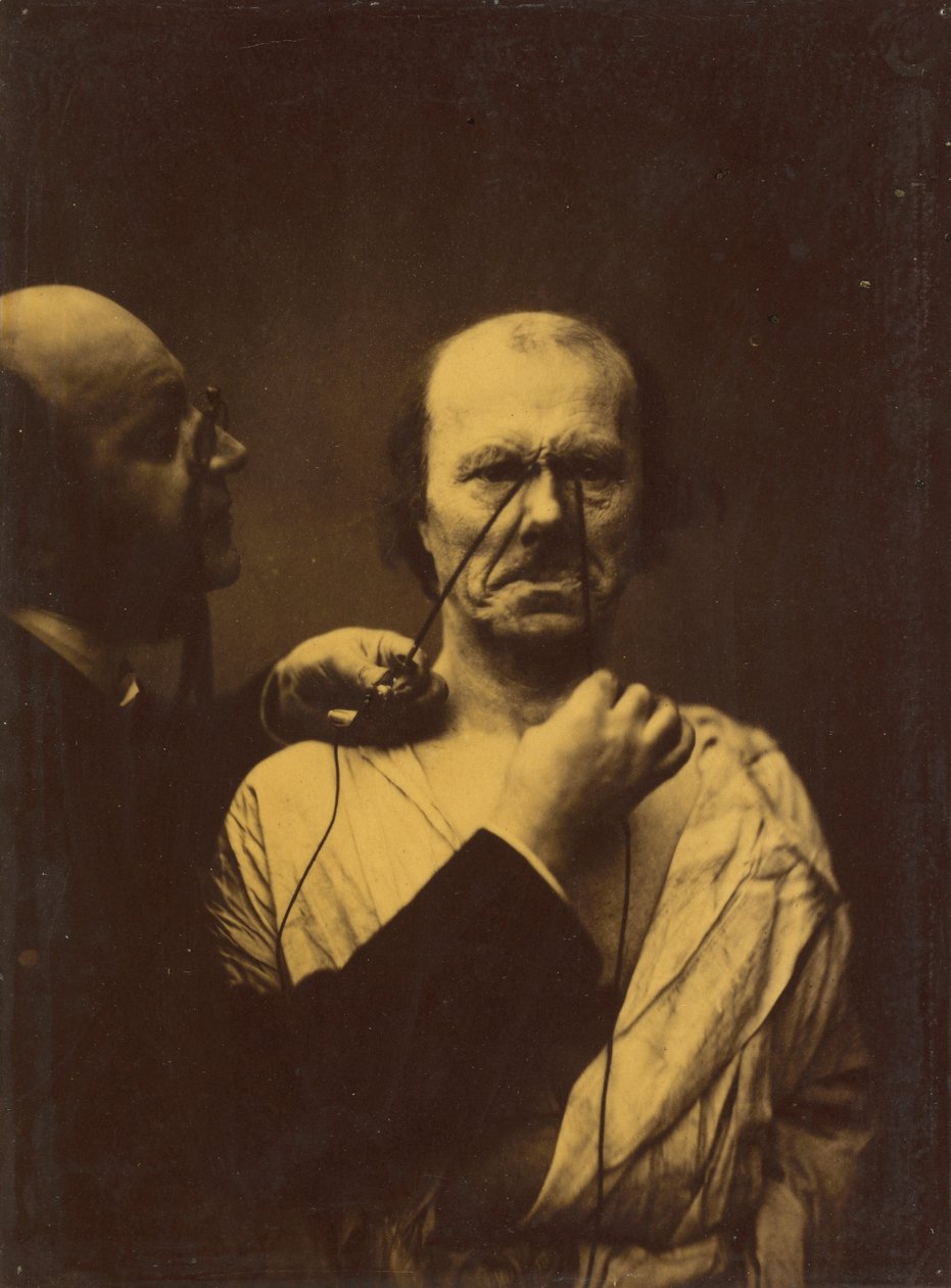 Agressivité, méchanceté, 1854-1856, imprimé 1862 (photo) - Guillaume-Benjamin-Armand Duchenne de Boulogne