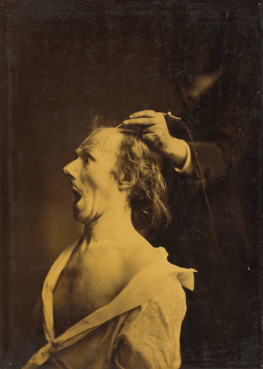 Stupeur, stupéfaction, étonnement, 1854-1856, imprimé en 1862 (photo) - Guillaume Benjamin Armand Duchenne de Boulogne