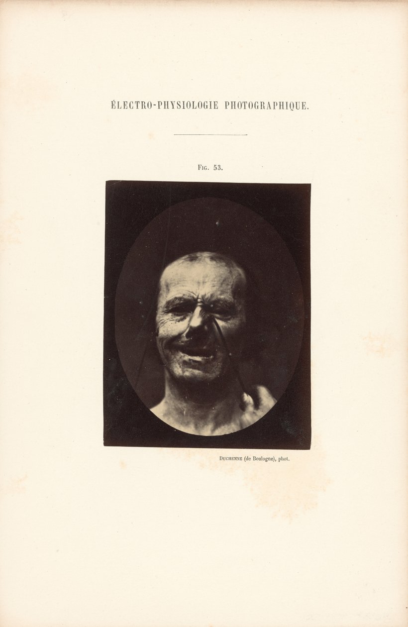 Électro-Physiologie Photographique, Figure 53 - Guillaume Benjamin Duchenne