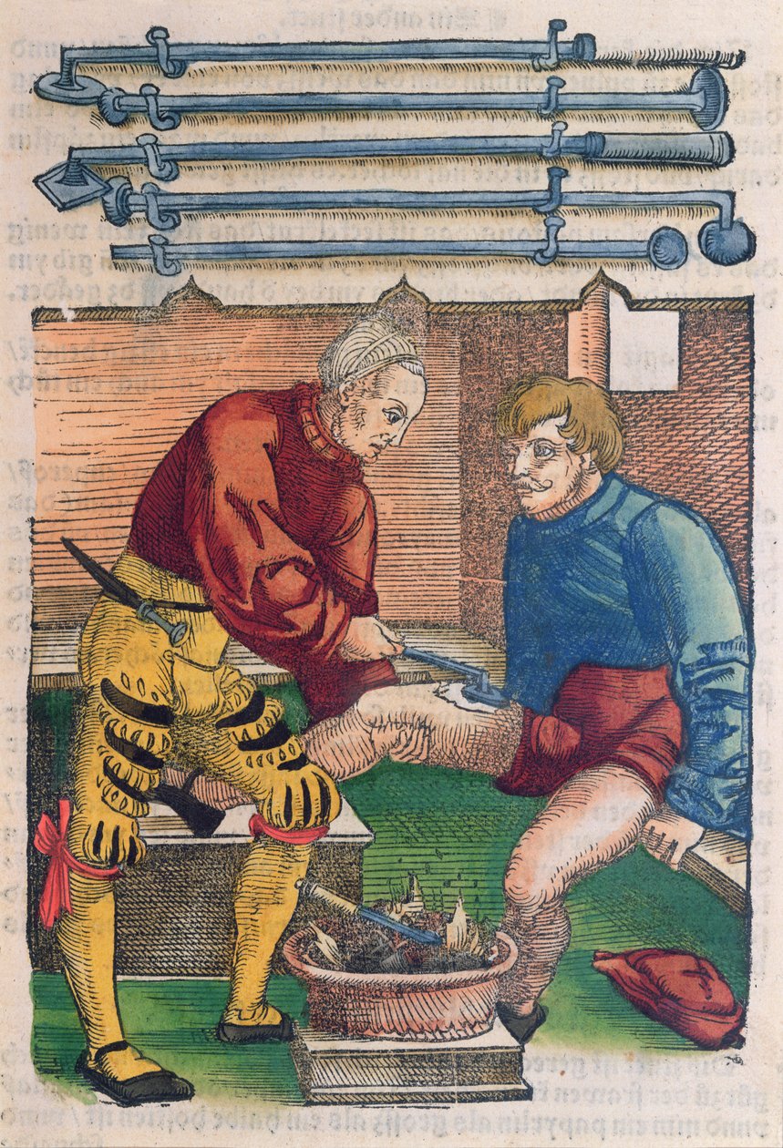 Cautérisation, illustration du 