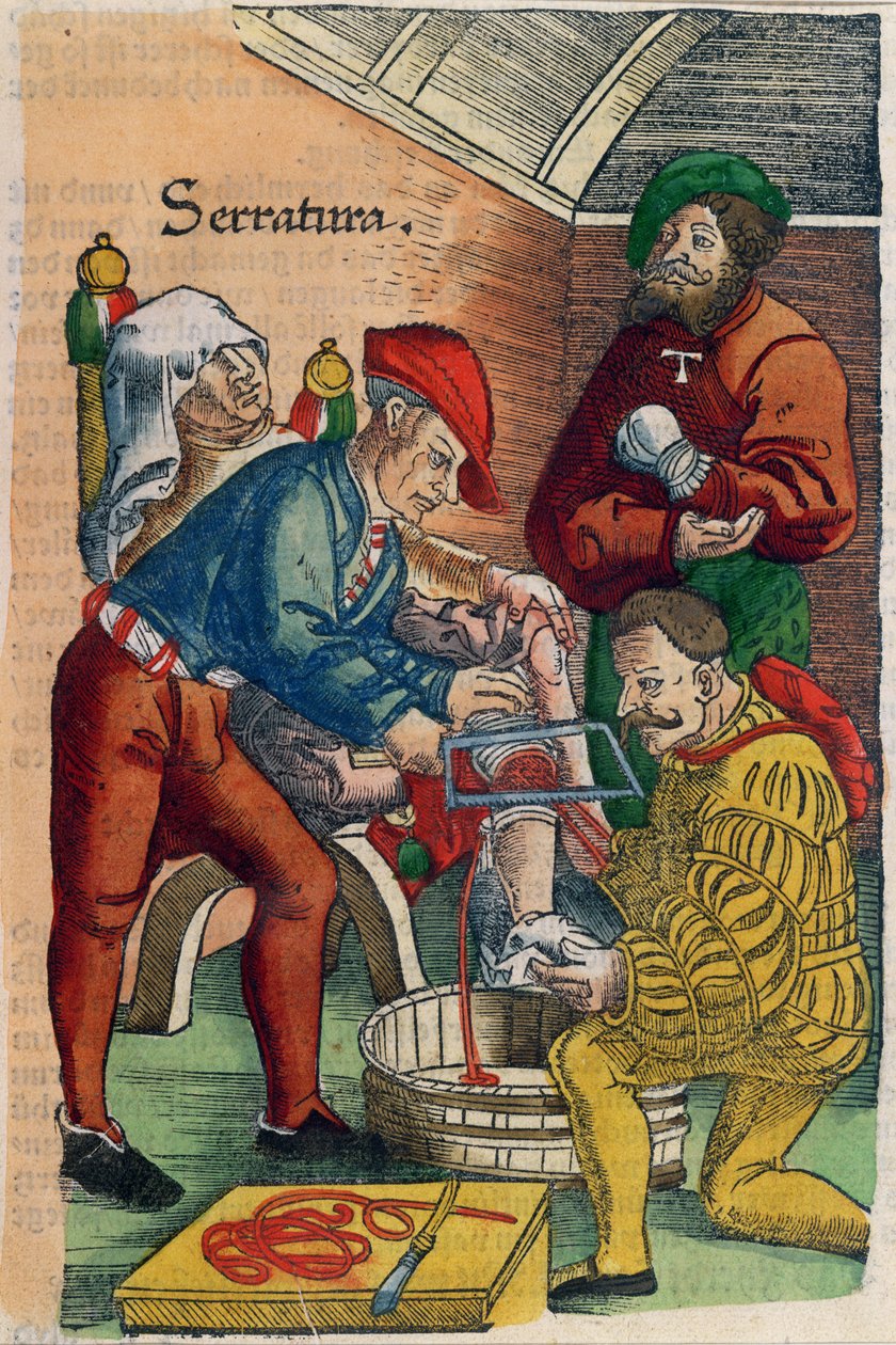 Une amputation, illustration du 
