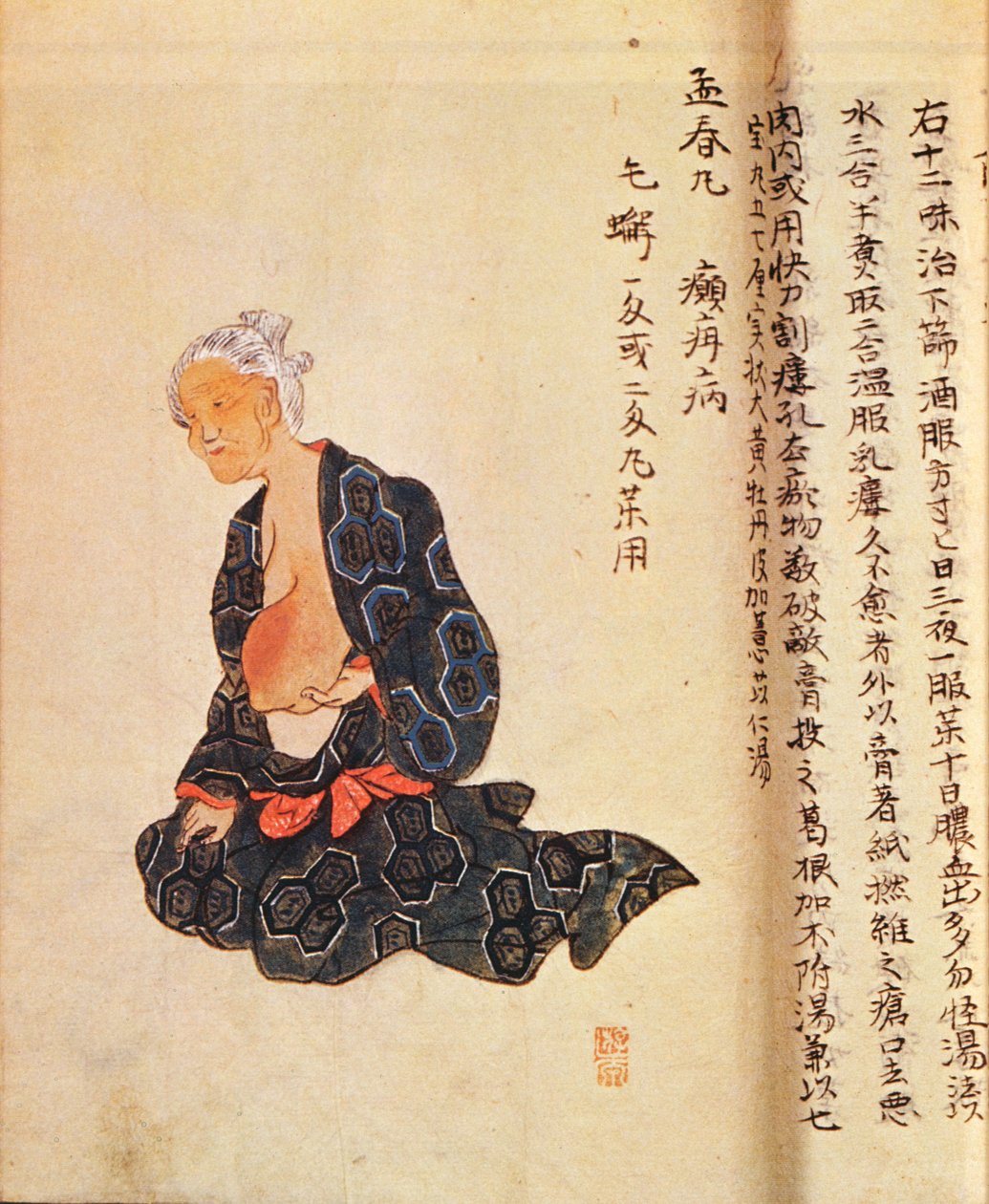 Le premier traitement chirurgical du cancer du sein sous anesthésie générale par Seishu Hanaoka en 1804 - Japanese School