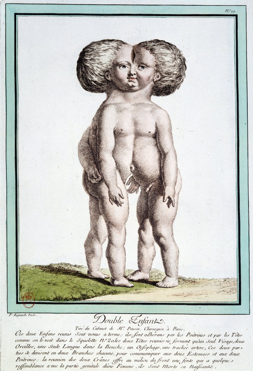 Enfants siamois - dans « Les déviations de la nature » par Régnault - Jean Baptiste Regnault