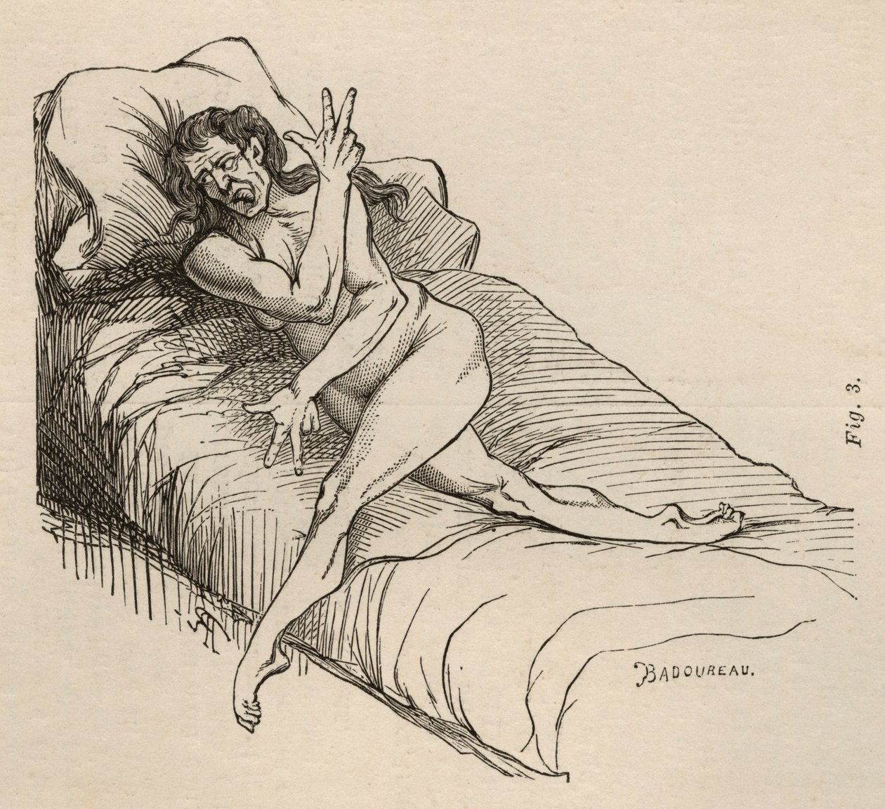 Épilepsie hystérique, attaque, contorsions, fig. 3 de 