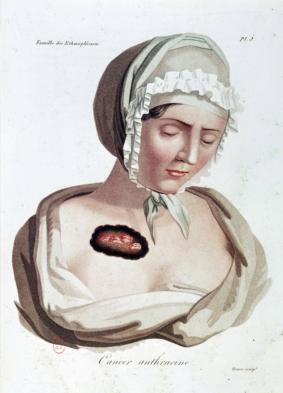 Cancer anthracine - Alibert, B.N. - Jean-Louis Alibert