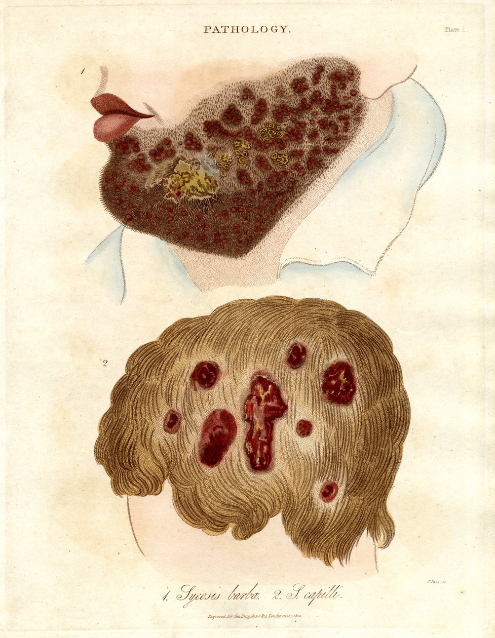 Illustration pathologique du sycosis barbae et du sycosis capilli - John Pass
