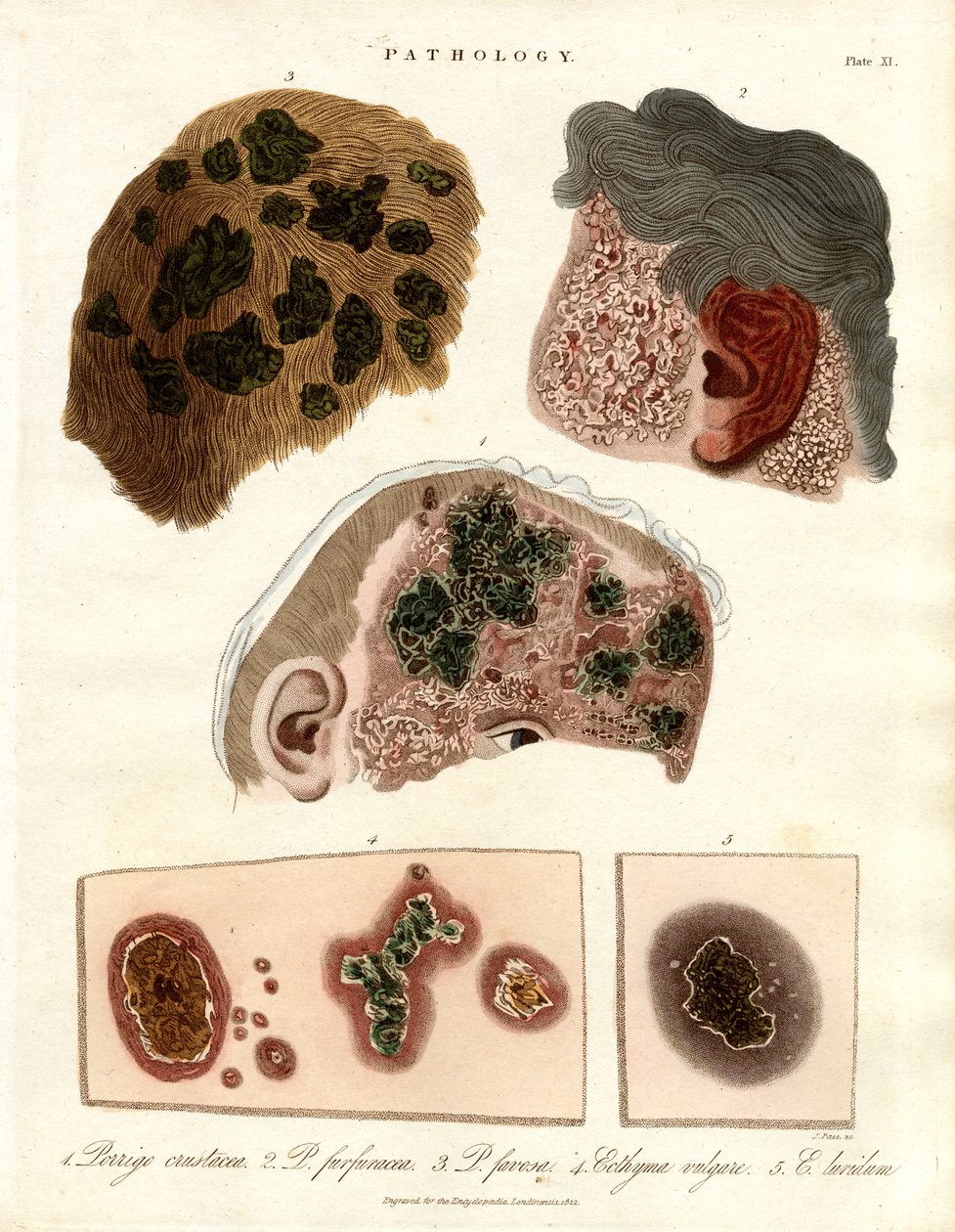 Modifications pathologiques de la peau : Porriga et Ecthyma - John Pass
