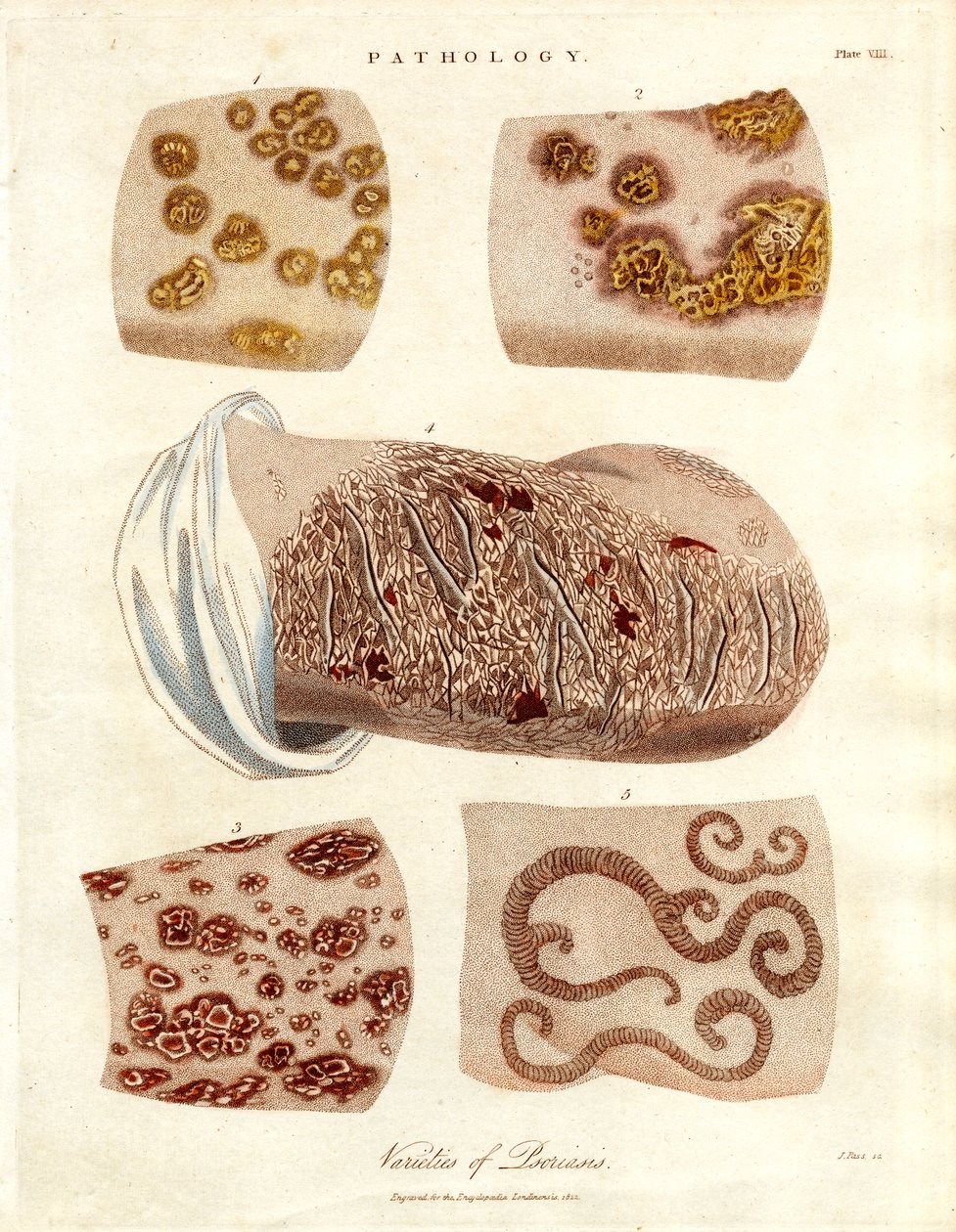 Modifications pathologiques de la peau : Variétés de psoriasis - John Pass