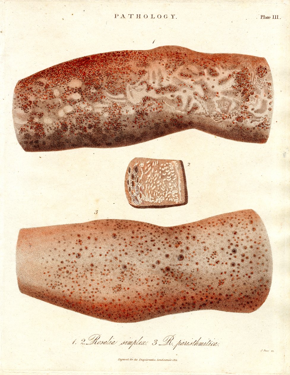 Éruptions cutanées - Roseola simplex et Roseola paristhmitica - John Pass