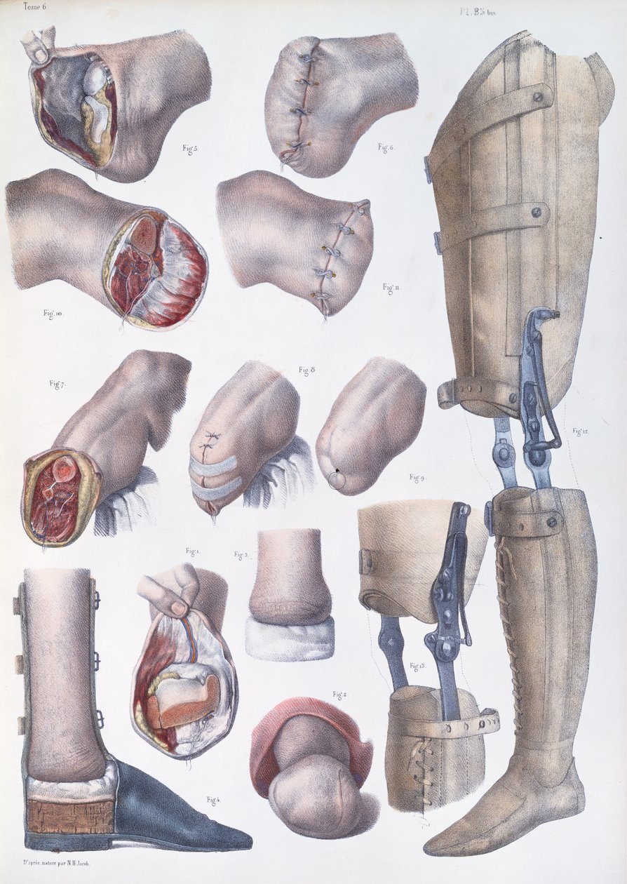 Amputations et Prothèses, planche de 