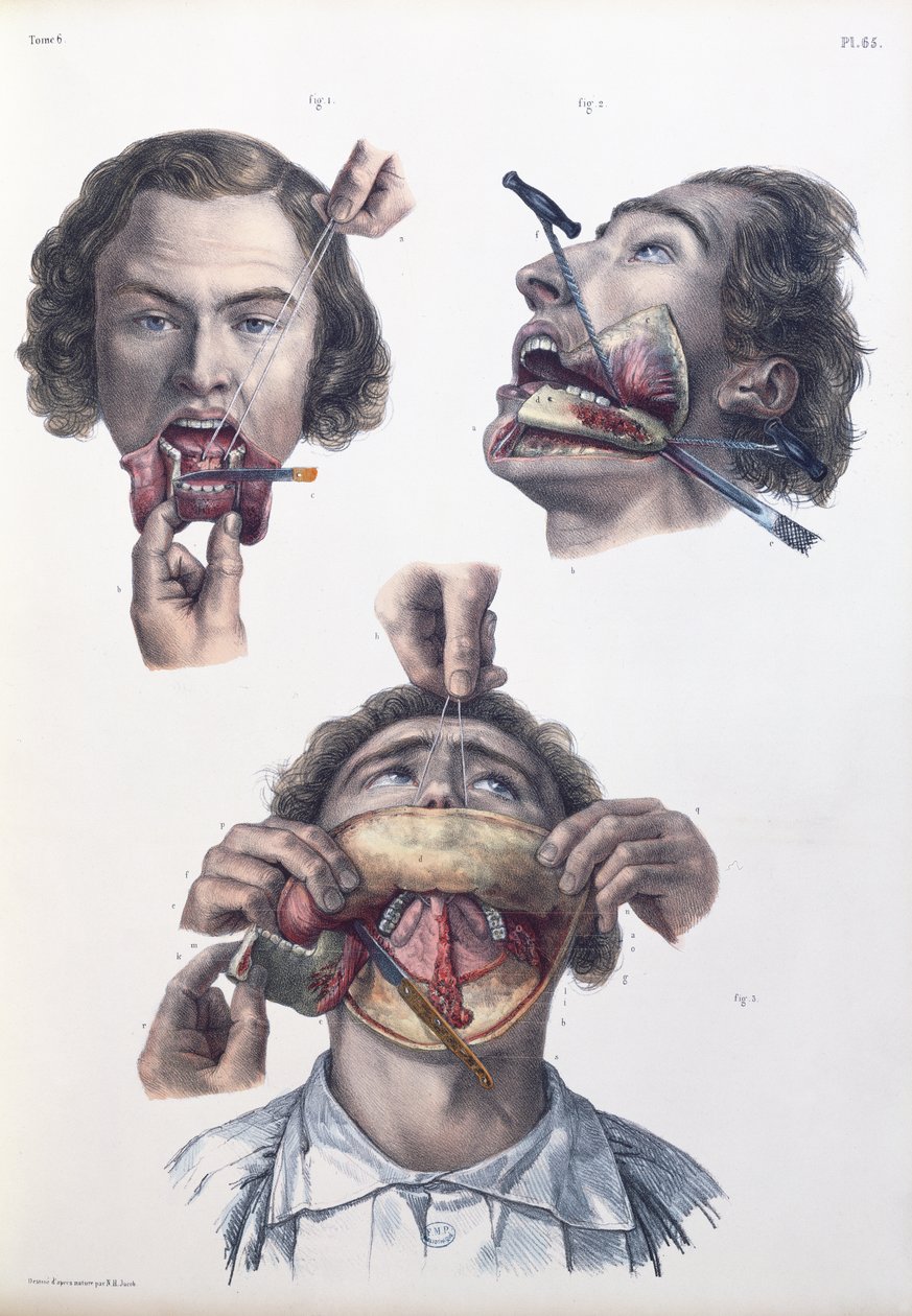 Opération sur la mâchoire inférieure, planche de 