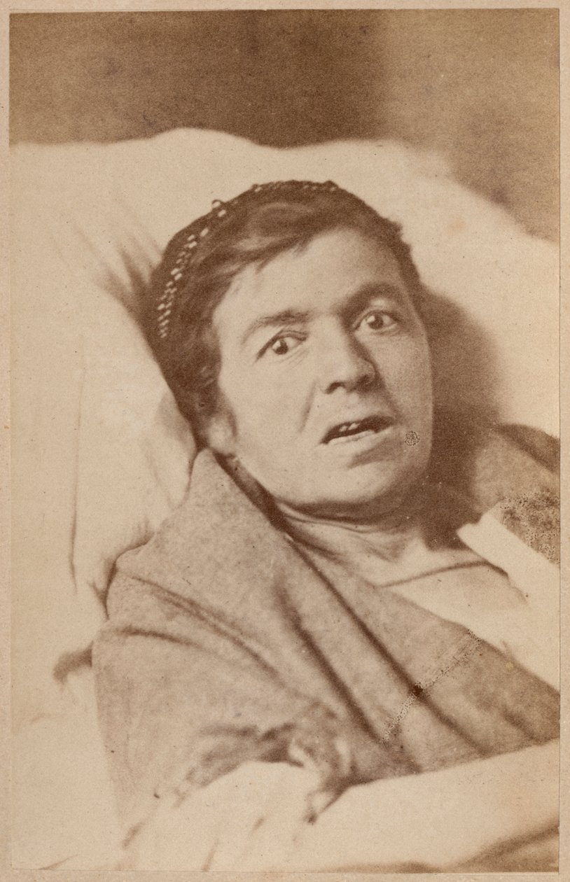 Épilepsie hystérique, contraction du visage, planche VIII de 