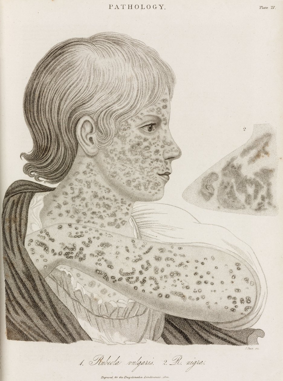 Maladies, rougeole Deux types de rougeole - John Pardon