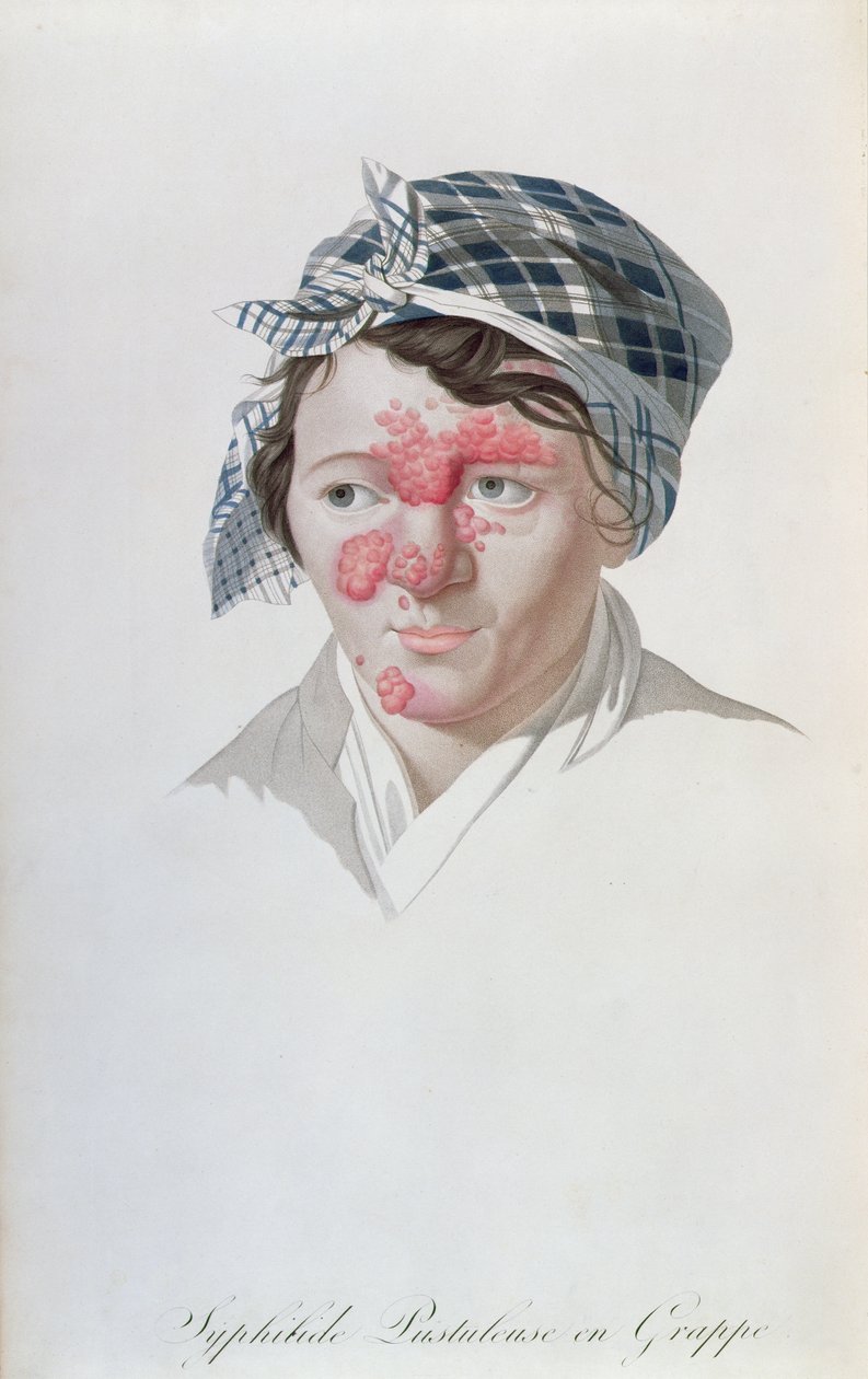 Pustules syphilitiques en grappe, d