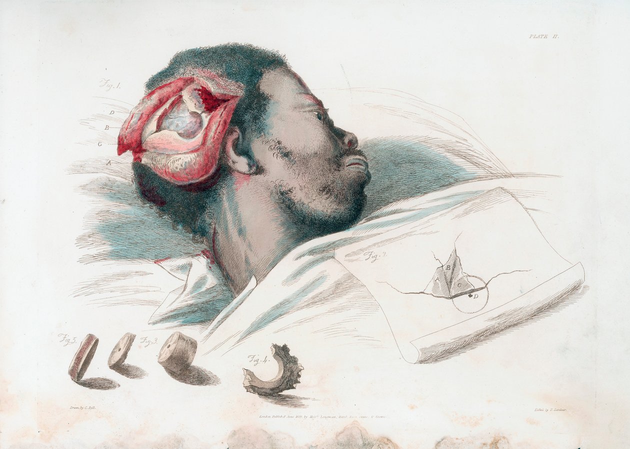 Vue de la blessure au crâne après trépanation et retrait du morceau d