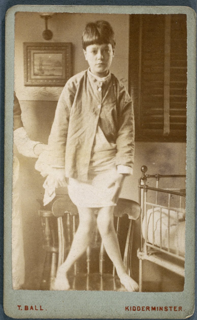 Maladies, Rachitisme (Rachitisme, jambes rachitiques) Enfant atteint de ...