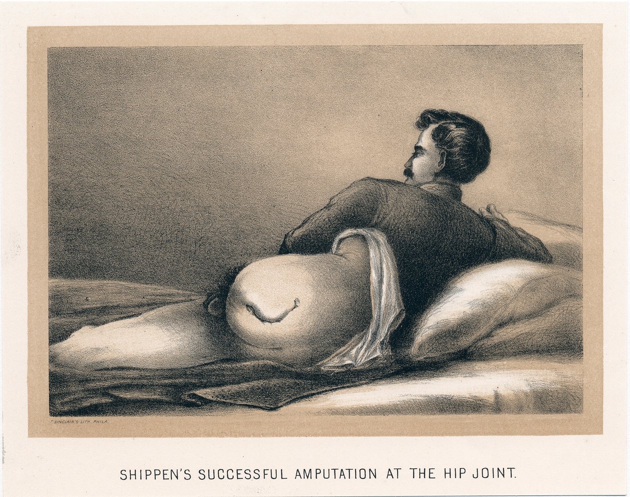 Amputation réussie de Shippen à l