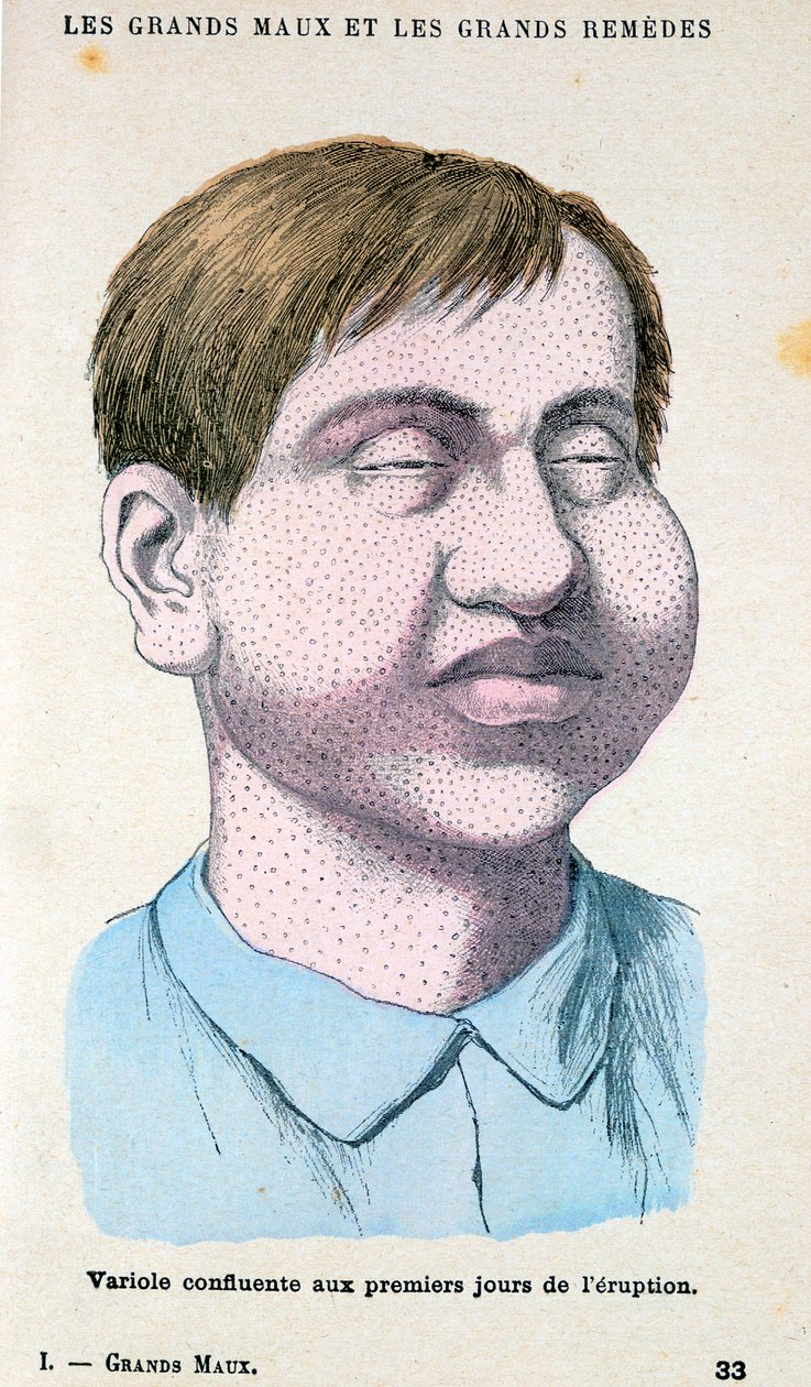 Victime de la variole, vers 1890 - Unbekannt