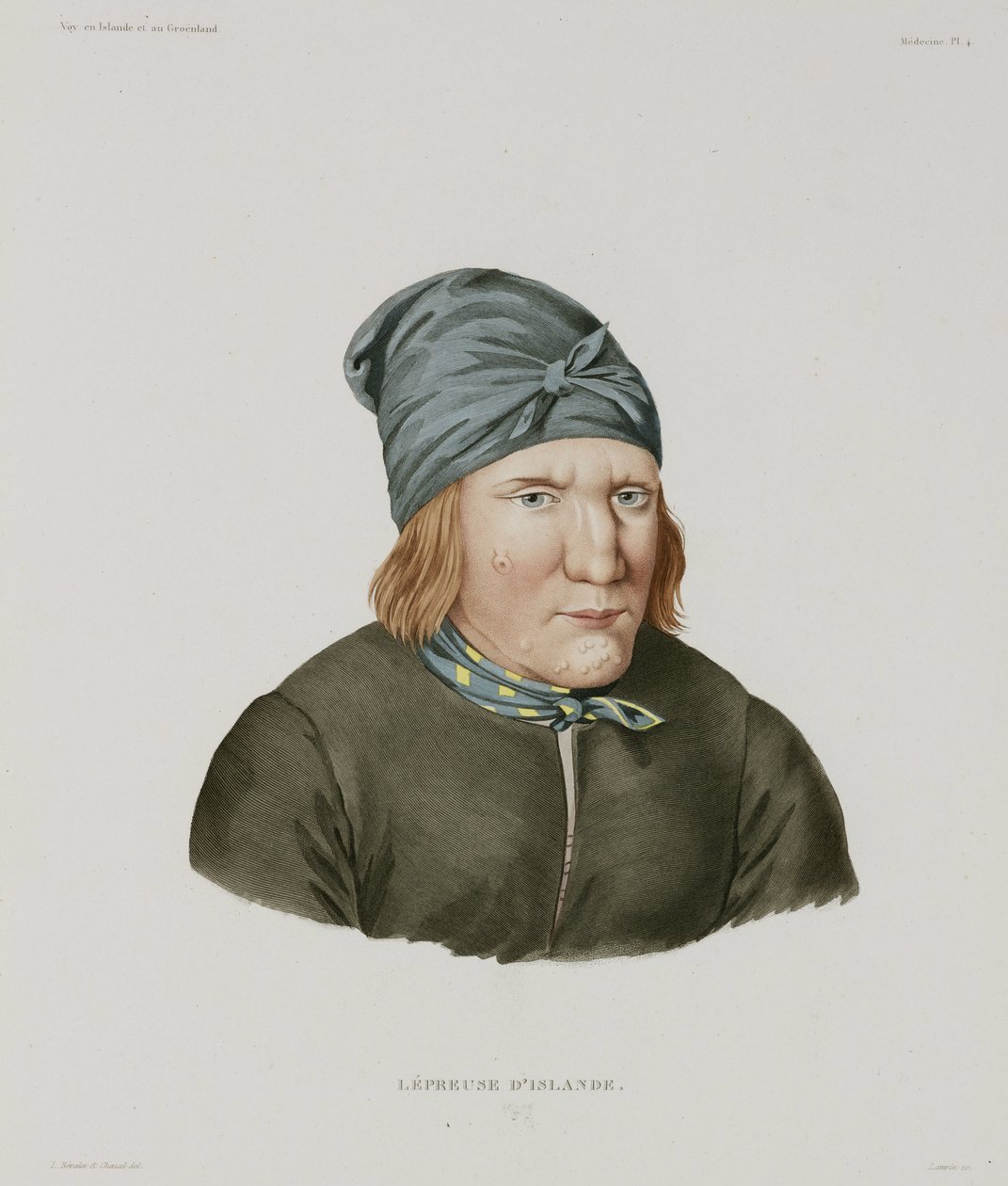 Maladies, Lèpre Femme lépreuse, Islande, début du 19ème siècle - Unbekannt