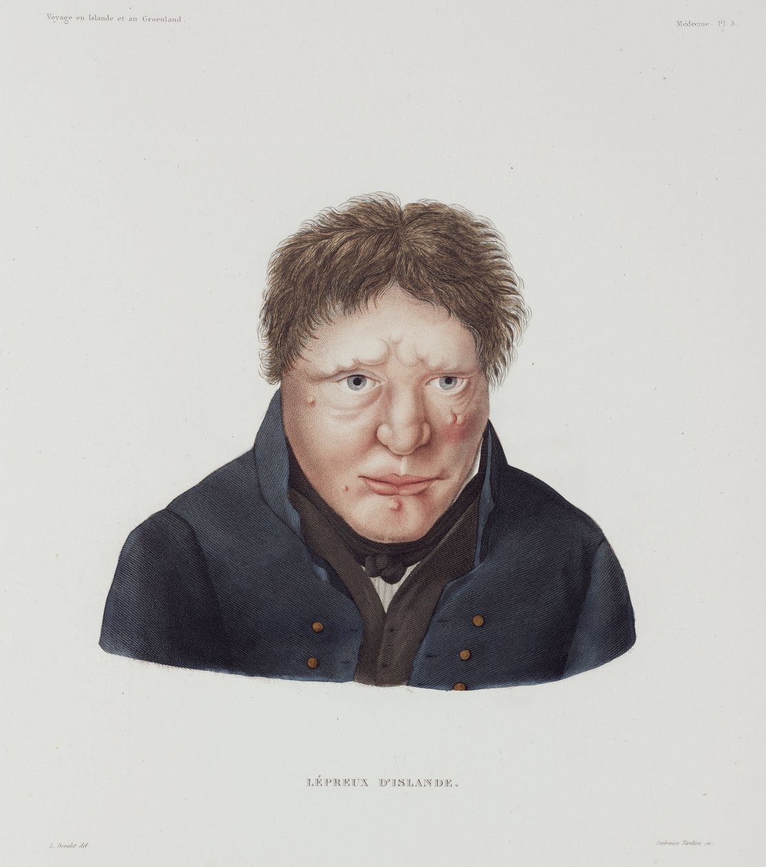 Maladies, lèpre Homme lépreux, Islande, début du 19ème siècle - Unbekannt