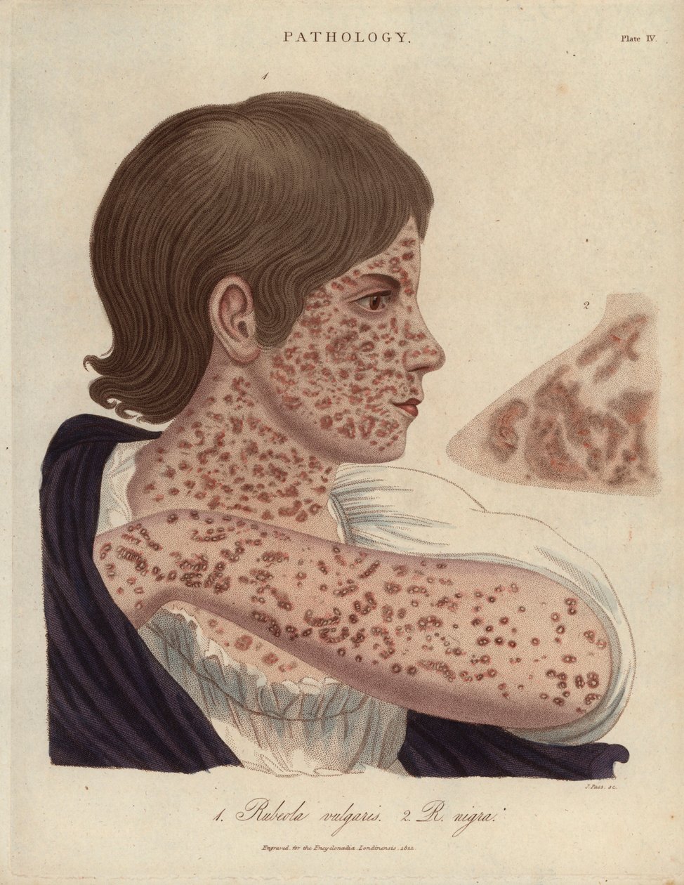 Rougeole et rubéole - Lithographie de John Pass, publiée dans «Encyclopedia Londinensis» par John Wilkes, édition J.Adlard, Londres - Unbekannter Künstler