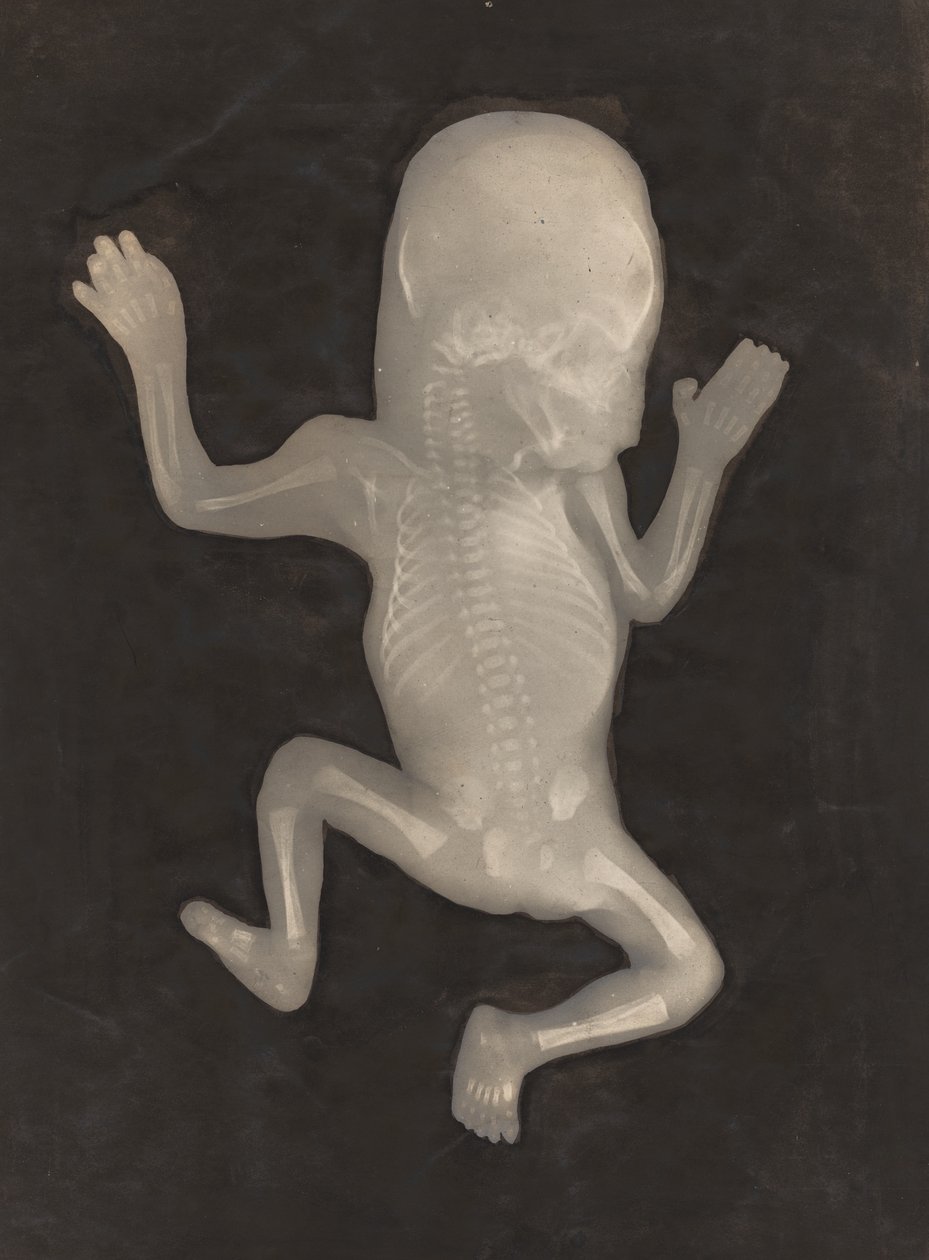 Degree of Ossification of a Five-Month-Old Fetus (Degré d
