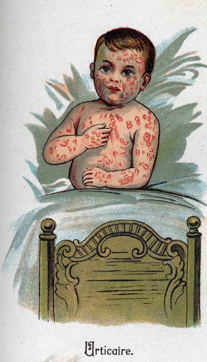 Maladies infantiles : Urticaire. dans « La nouvelle médecine naturelle » par F.E. Bilz - Unknown artist