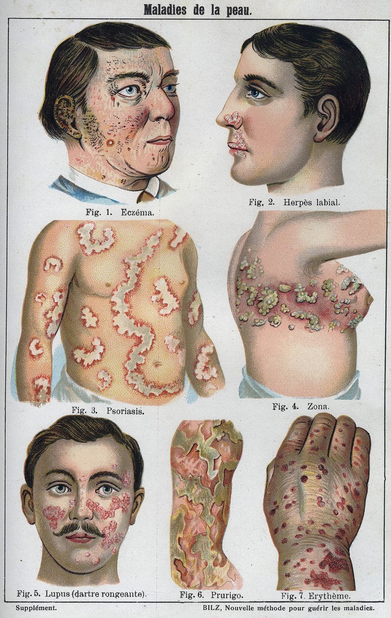 Maladies de la peau : Eczéma, herpès labial, psoriasis, zona, lupus (darter pourrissant), prurigo, érythème. Dans "La nouvelle médication naturelle" de F.E. Bilz - Unknown artist